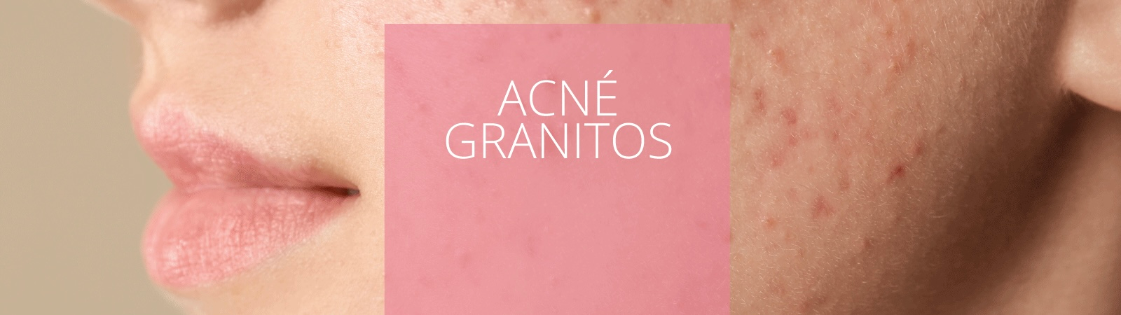 Acné/granitos