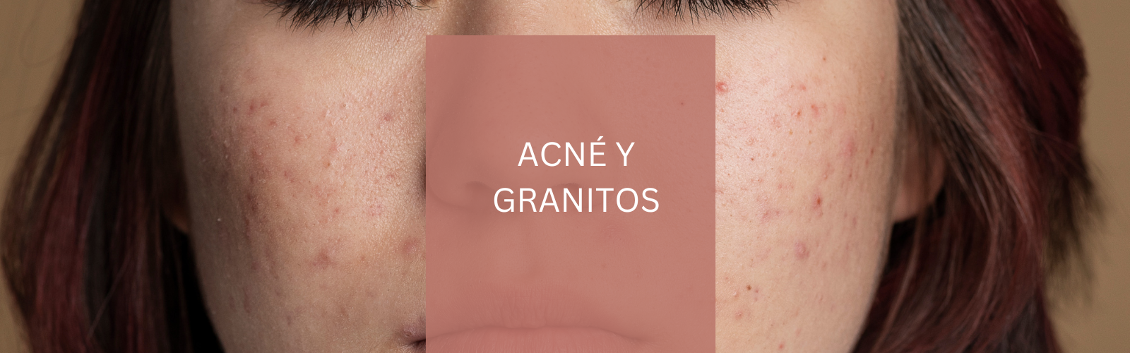 Acné/granitos