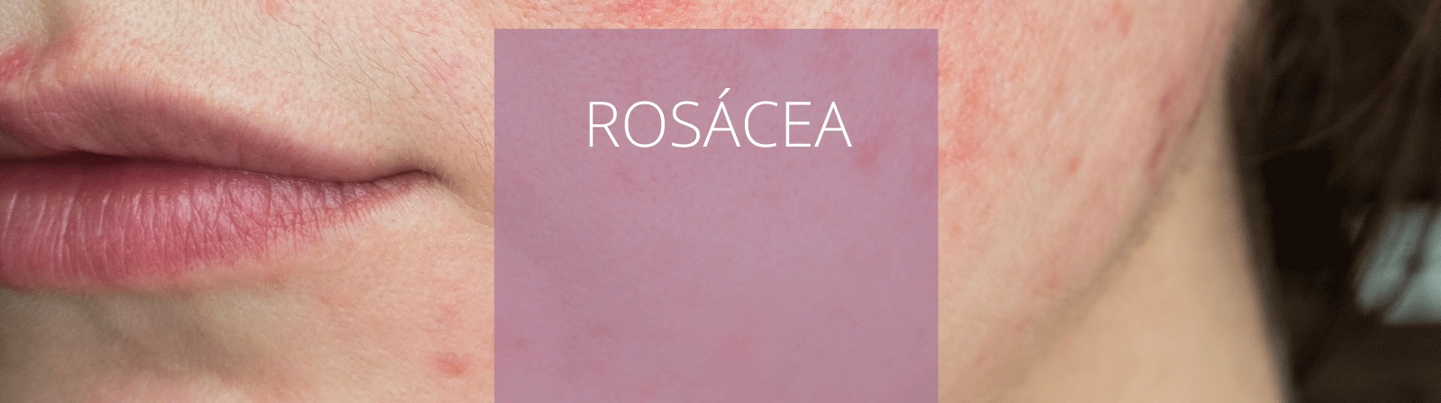 Rosácea
